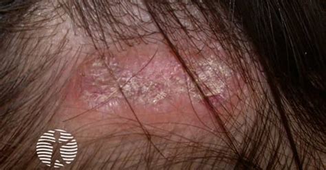 Discoid lupus erythematosus of scalp image