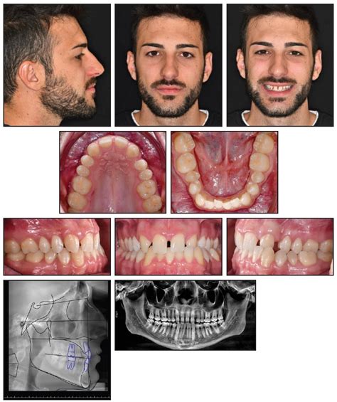 Tandem Skeletal Expander and MAPA Protocol for Palatal Expansion in ...