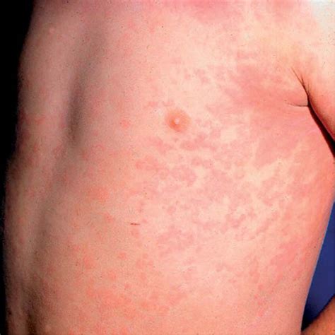 Anemia Rash Pictures