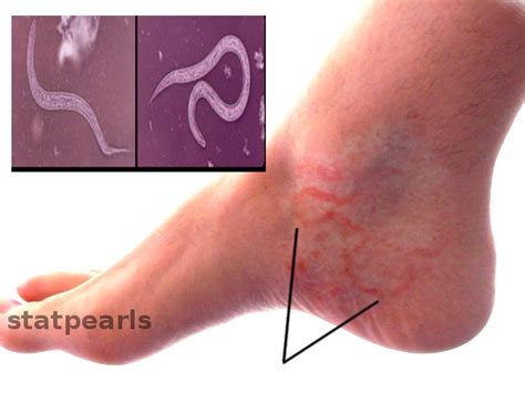 [Figure, Hookworm infection] - StatPearls - NCBI Bookshelf