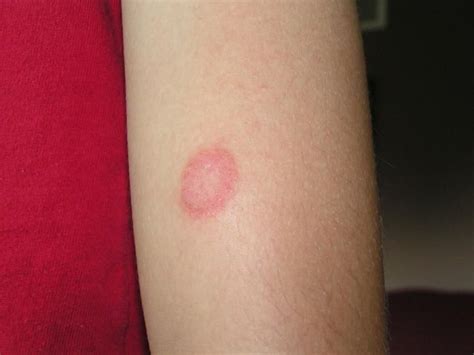 Brown Recluse Spider Bite Images