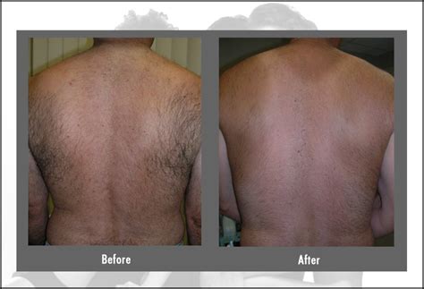 Laser Hair Removal | Cost, Before & After, FAQ | Hartford CT