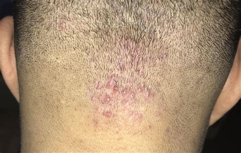 Mild Folliculitis Scalp Treatment