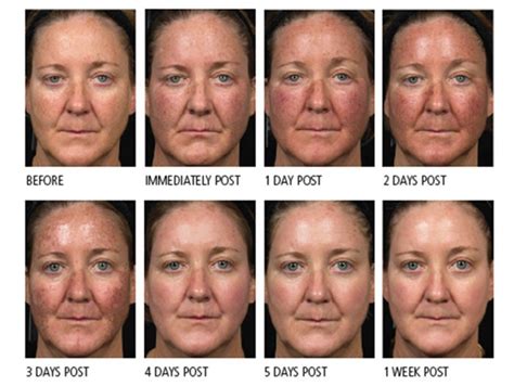 Photodynamic Therapy (PDT) – Dermatology Matters