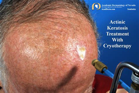 Actinic Keratosis: Treatment-Cryotherapy - Academic Dermatology of Nevada