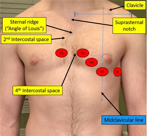 Proper Electrocardiogram (ECG/EKG) Lead Placement | ECGEDU