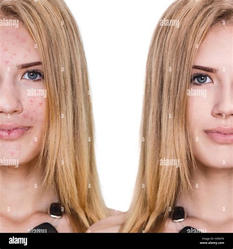 Girl with acne before and after treatment Stock Photo - Alamy