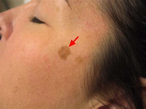 Lentigo (Liver Spots): Pictures, Causes, Removal Prevention, 40% OFF