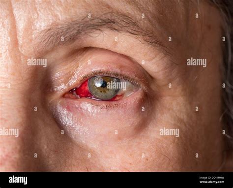 Eye hemorrhage hi-res stock photography and images - Alamy