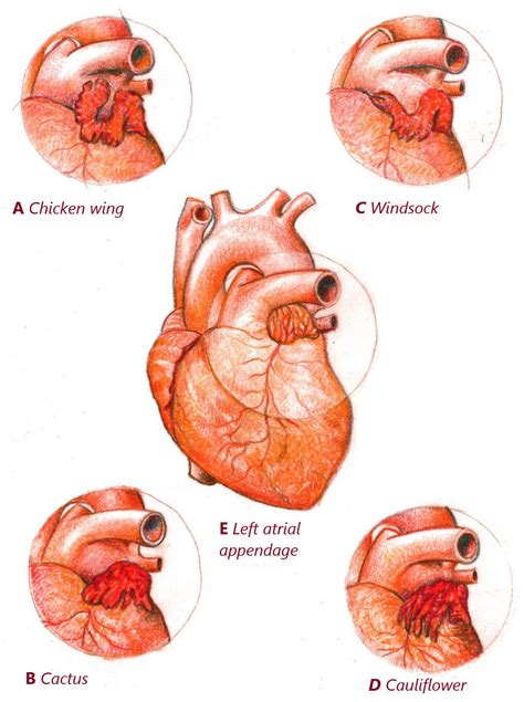 Different Techniques of Surgical Left Atrial Appendage Closure and ...