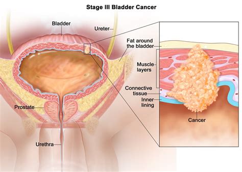 Bladder Cancer - Causes, Symptoms, Signs, Diagnosis, Stages, Treatment