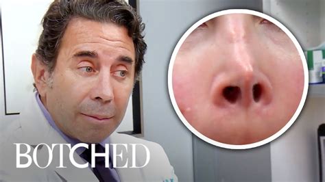 Botched Nose Job