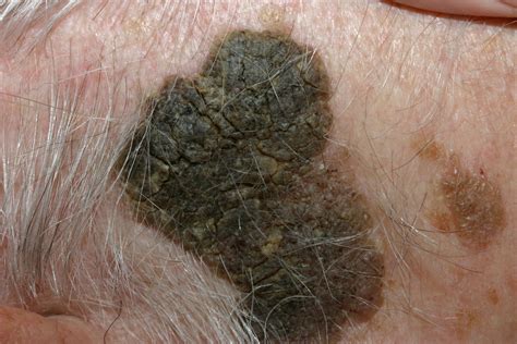 Seborrheic Keratosis - Causes, Symptoms, Home Treatment