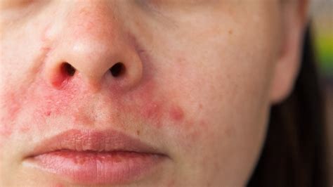 Perioral Dermatitis: Causes, Symptoms, Treatment | Gladskin