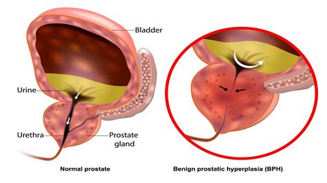 What Are the Symptoms of BPH? | HALO Diagnostics