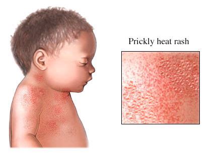 First Aid Heat Rash - Health Safety & Environment