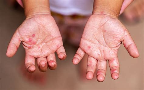 Hand Foot Mouth Disease (HFMD): How to Prevent and Treat - HealthXchange.sg