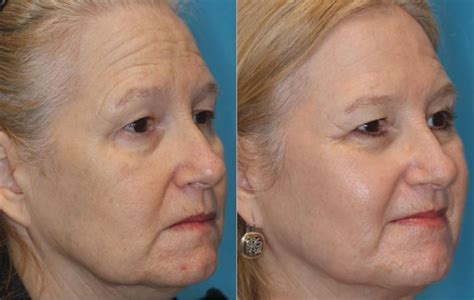 Halo Laser For Under Eye Wrinkles - Cosmetic Surgery Tips