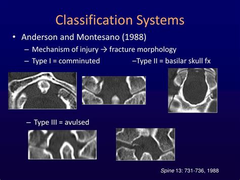 PPT - Occipital Condyle Fractures: Epidemiology, Classification, and ...