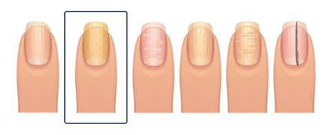 What Your Fingernails Say About Your Health | What's Good by V