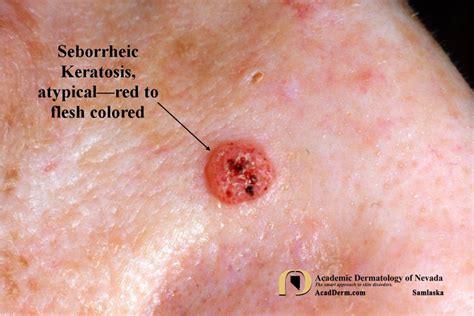 Irritated Seborrheic Keratosis