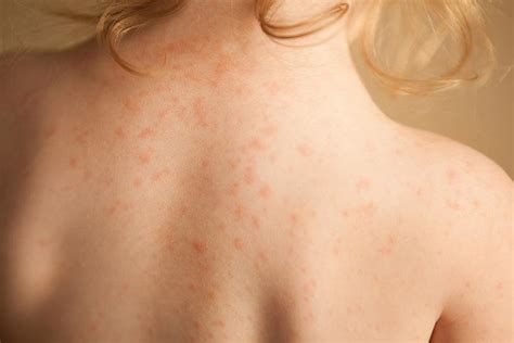 Heat Rash Treatment Rash Under The Breast: Causes And When To See A ...