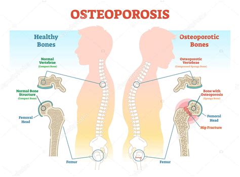 Osteoporosis - Functional Medical Corporation