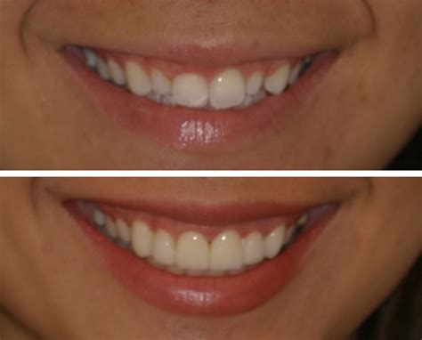 Veneers Before And After Pictures | Before And After