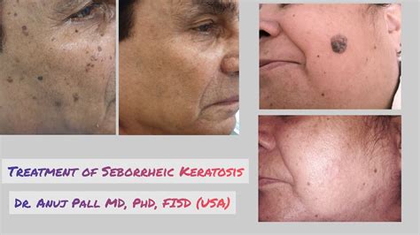 New Options For The Treatment Of Extensive Seborrheic, 55% OFF