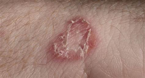 Dos and don'ts to treat fungal skin infections | TheHealthSite.com