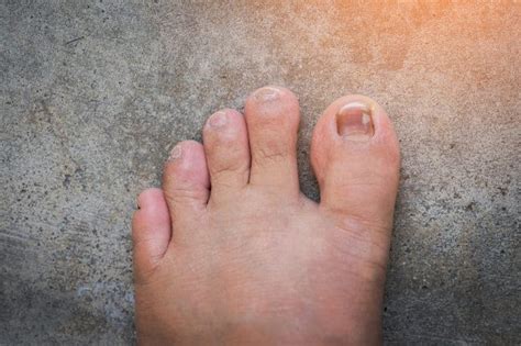 Toenail Discoloration | Causes, Prevention & Treatments