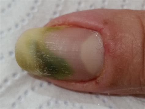 Going green: The complexities of the green nail syndrome