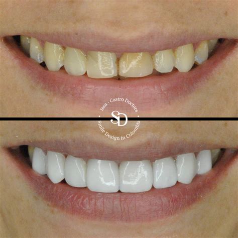 Smile Design | Porcelain Veneers – Smiledesignincolombia