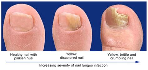 Toe Fungus Infection