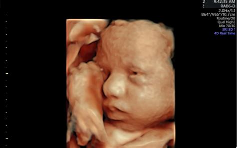 3D ULTRASOUND & 4D ULTRASOUND SYDNEY NSW