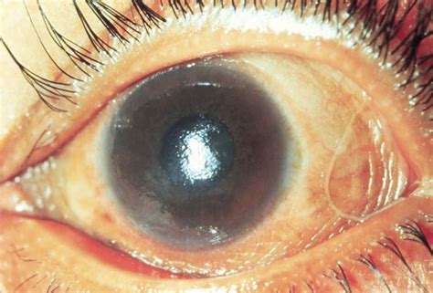 Vitamin A Deficiency Eye