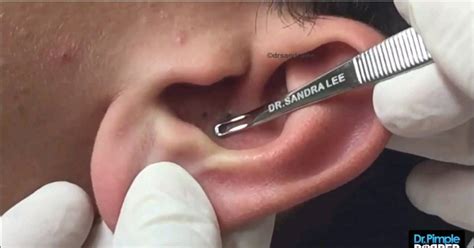 Sounds Gross! Dr Pimple Popper Squeezes Blackheads In A Man’s EAR ...