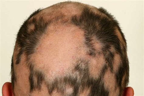 Alopecia Areata: Treatment, Symptoms, Causes, and More