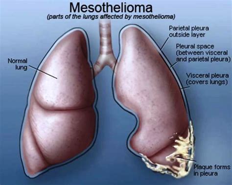 What is Pleural Mesothelioma? What are the symptoms? - Best Treatment Tips