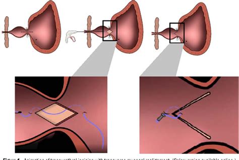 [PDF] Transurethral incision with transverse mucosal realignment for ...