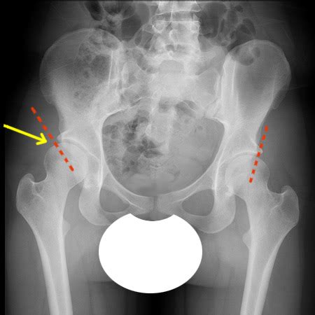 Congenital Hip Dysplasia Symptoms & Treatments | Orthopedics