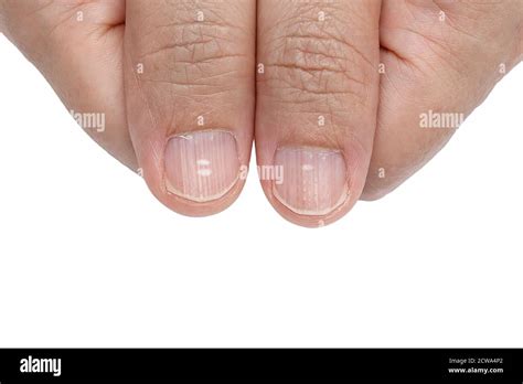 White spots and Vertical ridges on the fingernails symptoms deficiency ...