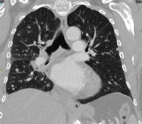 Diffuse pulmonary metastases, CT scan - Stock Image - C036/6393 ...