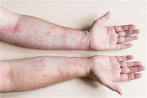 12 Prevention Tips and Natural Remedies for Contact Dermatitis