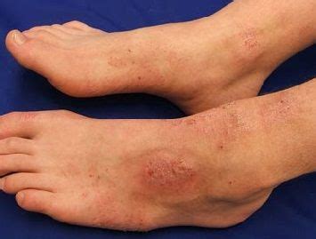 Atopic dermatitis foot rash. Find out about the causes, symptoms and ...