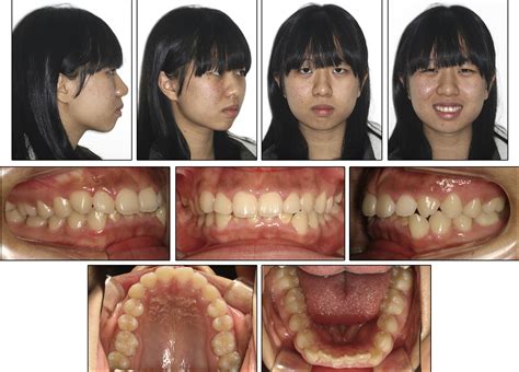 Figure 1 from Vertical control of a Class II deep bite malocclusion ...