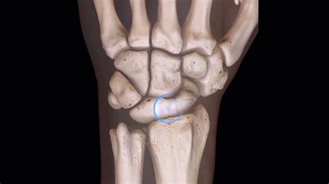 Scapholunate Ligament - and Clinical Significance - YouTube