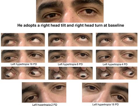 Trochlear Nerve Palsy Eye Position