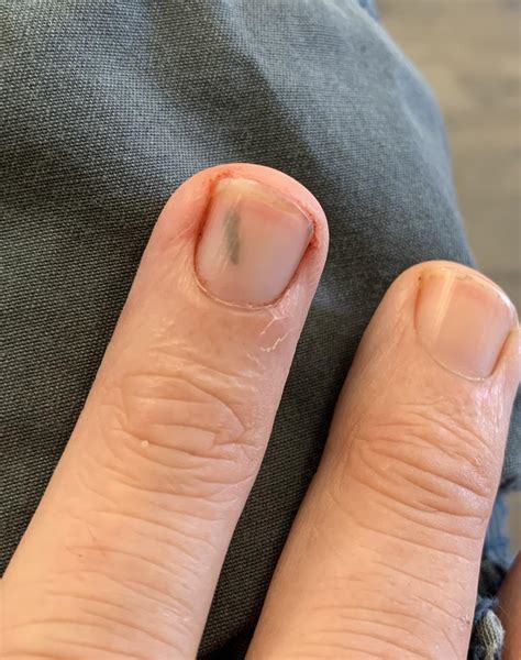 I got a splinter under my fingernail : r/Wellthatsucks