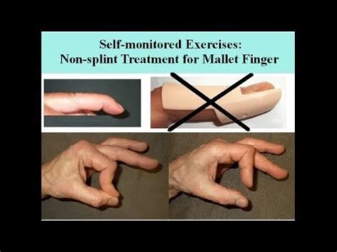 Mallet finger injury no splint treatment by hand exercises. Extensor ...